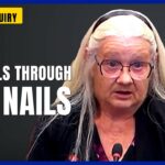 đ She Says Crystals Grew Through Her Nails â and She Could See Her Bone đ She Says Crystals Grew Through Her Nails â and She Could See Her Bone